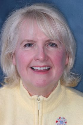 Porcelain Veneers: Case 20: Philadelphia, PA - After