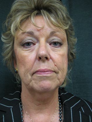 QuickLift Case 5 - Before