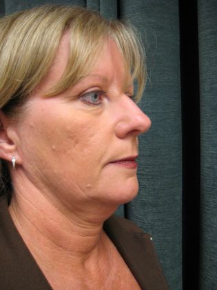 QuickLift: Case 7 - Oblique Preop