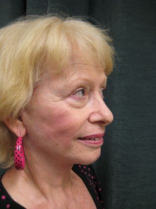 QuickLift: Case 8 - Oblique Postop