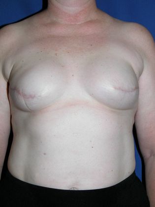 Breast Reconstruction / Mastectomy: Case 1 (10725) - Expansion completed