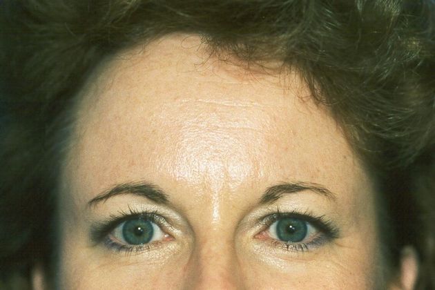 Facial Eyelid Surgery / Blepharoplasty: Case 2 (05872) - Before