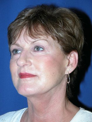 Facial Facelift / Necklift: Case 3 (09917) - After