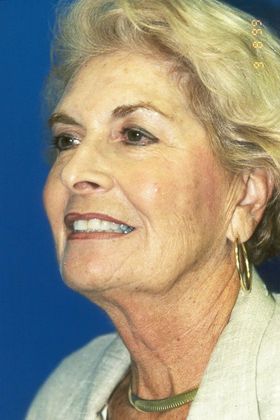 Facial Facelift / Necklift: Case 4 (06408) - Before