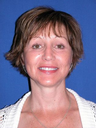 Facial Facelift / Necklift: Case 5 (10598) - After