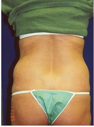 Body Liposuction: Case 1 (10034) - Before