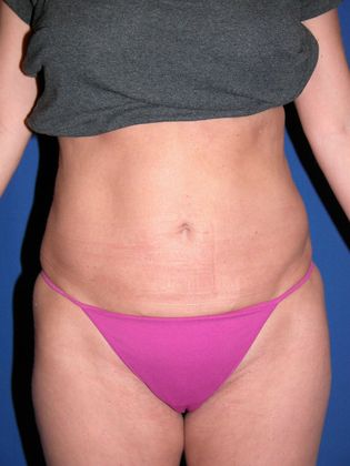 Body Liposuction: Case 1 (10034) - After