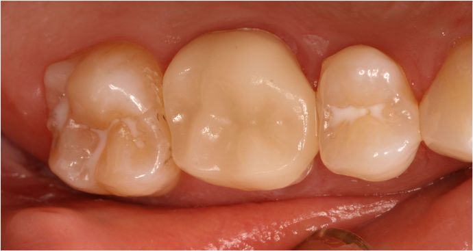Cerec One Visit Crowns Case 2 - Amalgam replacement with Cerec technology - After