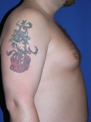 Male Breast / Gynecomastia: Case 1 (10198) - Before