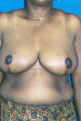 Breast Reduction Case 2 (06001) - After