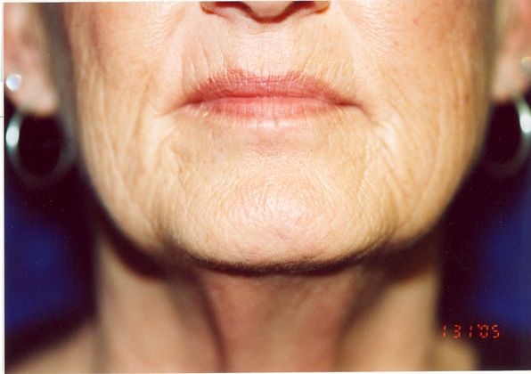 Facial Laser Resurfacing: Case 2 (09917) - Before, close-up