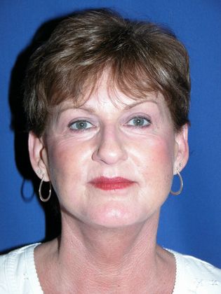 Facial Laser Resurfacing: Case 2 (09917) - After