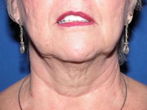 Facial Facelift / Necklift: Case 8 (10477) - Before