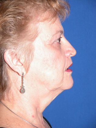 Facial Facelift / Necklift: Case 8 (10477) - Before