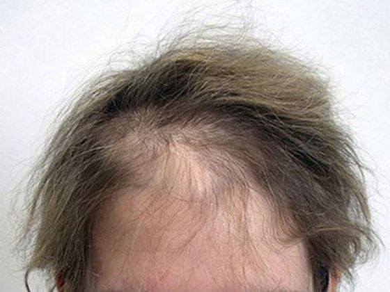 Hair Transplant - Female: Frontal FUT (3) - Before female hair transplant