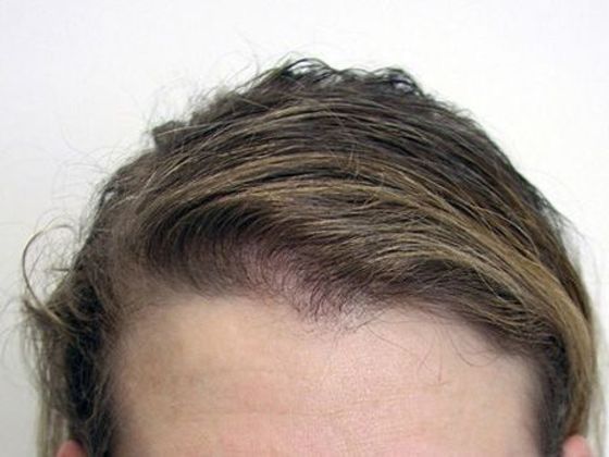 Hair Transplant - Female: Frontal FUT (3) - After female hair transplant