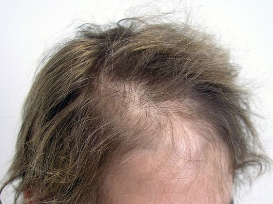 Hair Transplant - Female: Frontal FUT (3) - Before female hair transplant