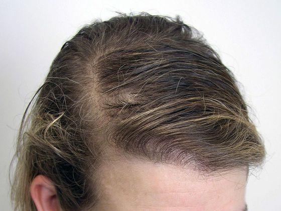 Hair Transplant - Female: Frontal FUT (3) - After female hair transplant