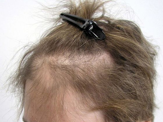 Hair Transplant - Female: Frontal FUT (3) - Before