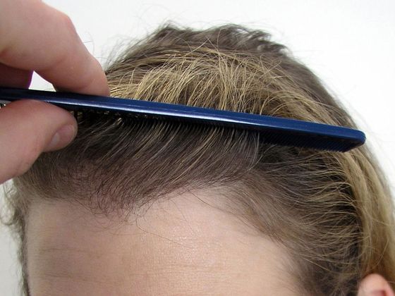 Hair Transplant - Female: Frontal FUT (3) - After female hair transplante hairlien