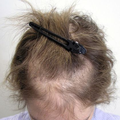 Hair Transplant - Female: Frontal FUT (3) - Before