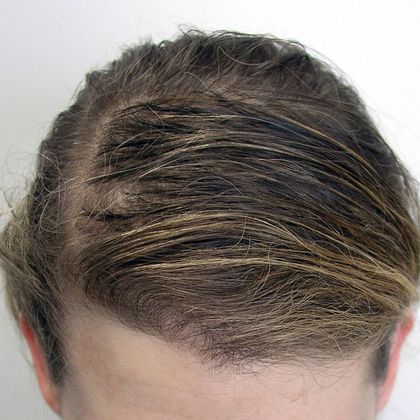 Hair Transplant - Female: Frontal FUT (3) - After one hair transplant procedure