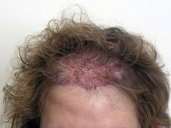 Hair Transplant - Female: Frontal FUT (3) - Immediately post-op female hair transplant