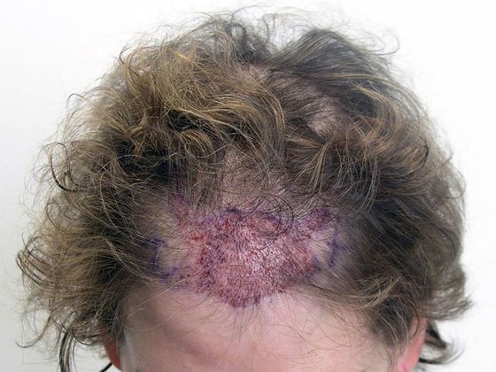 Hair Transplant - Female: Frontal FUT (3) - Immediately post-op female hair transplant