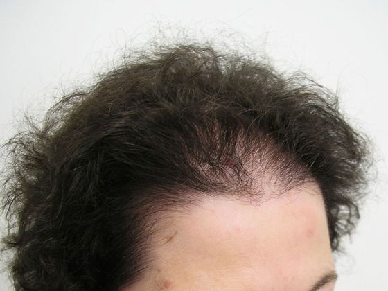 Hair Transplant - Female: Front/Top FUT - Before female hair transplant