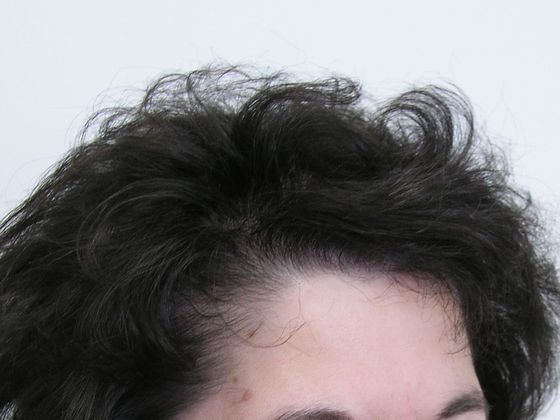 Hair Transplant - Female: Front/Top FUT - After female hair transplant