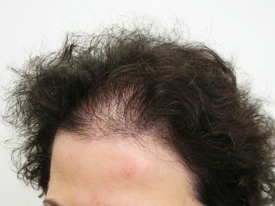 Hair Transplant - Female: Front/Top FUT - Before female hair transplant