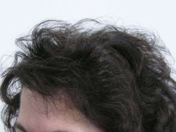 Hair Transplant - Female: Front/Top FUT - After female hair transplant