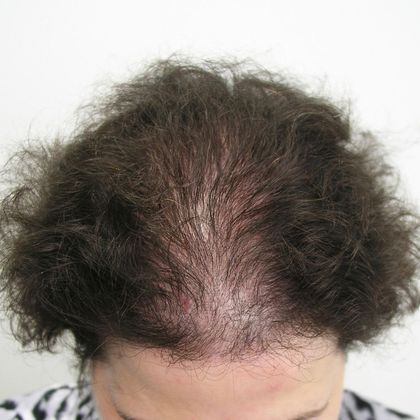Hair Transplant - Female: Front/Top FUT - Before female hair transplant
