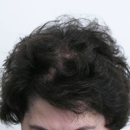 Hair Transplant - Female: Front/Top FUT - After female hair transplant