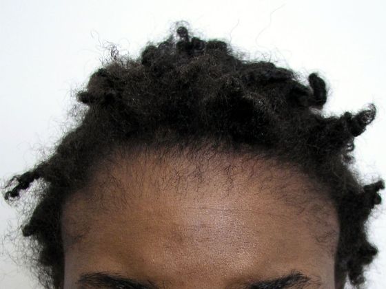 Hair Transplant - Female: Traction Alopecia FUT (5) - Before female hair transplant