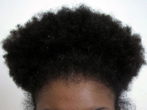 Hair Transplant - Female: Traction Alopecia FUT (5) - After female hair transplant