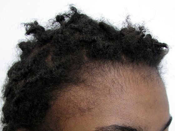 Hair Transplant - Female: Traction Alopecia FUT (5) - Before hair restoration