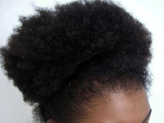 Hair Transplant - Female: Traction Alopecia FUT (5) - After 1 hair transplant procedure