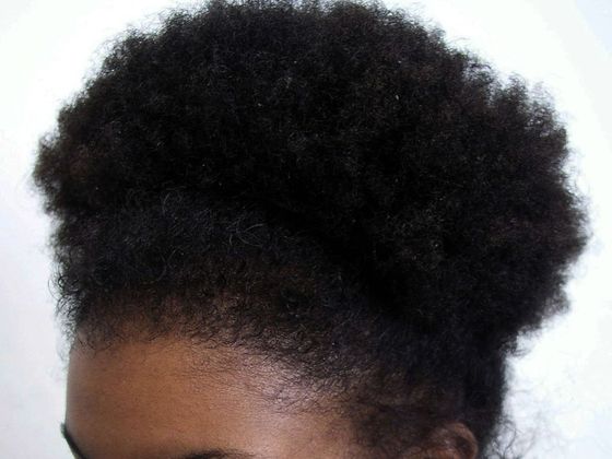 Hair Transplant - Female: Traction Alopecia FUT (5) - After female hair transplant