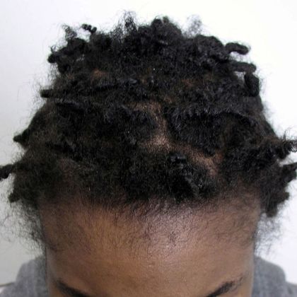 Hair Transplant - Female: Traction Alopecia FUT (5) - Before female hair transplant