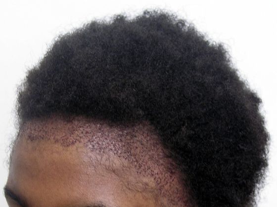 Hair Transplant - Female: Traction Alopecia FUT (5) - Immediately post-op female hair transplant