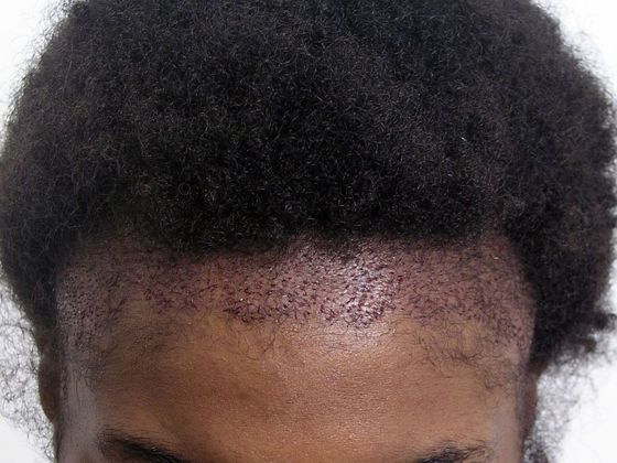 Hair Transplant - Female: Traction Alopecia FUT (5) - Immediately post-op female hair transplant