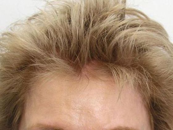Hair Transplant - Female: Hairline FUT (6) - After female hair transplant