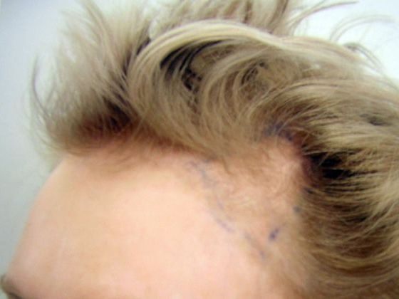 Hair Transplant - Female: Hairline FUT (6) - Before female hair transplant