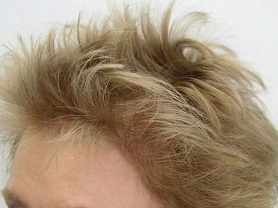 Hair Transplant - Female: Hairline FUT (6) - After 1 hair transplant