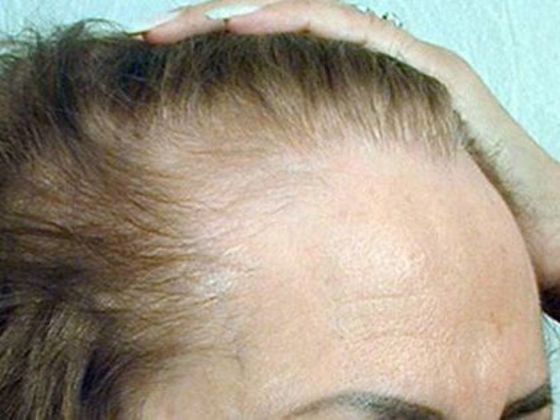 Hair Transplant - Female: Hairline FUT (12) - Before female hair transplant