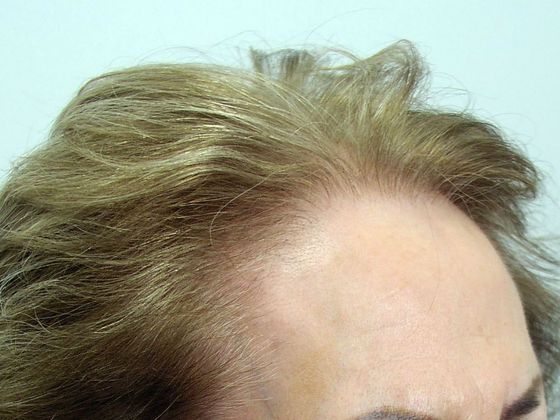 Hair Transplant - Female: Hairline FUT (12) - After female hair transplant