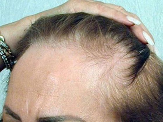 Hair Transplant - Female: Hairline FUT (12) - Before