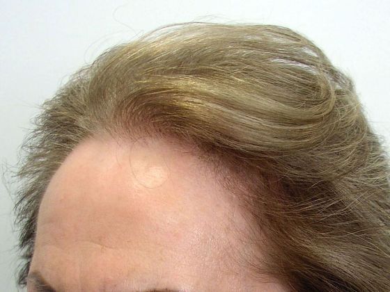 Hair Transplant - Female: Hairline FUT (12) - After