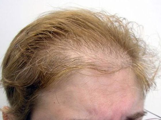 Hair Transplant - Female: Frontal FUT (5) - Before female hair transplant